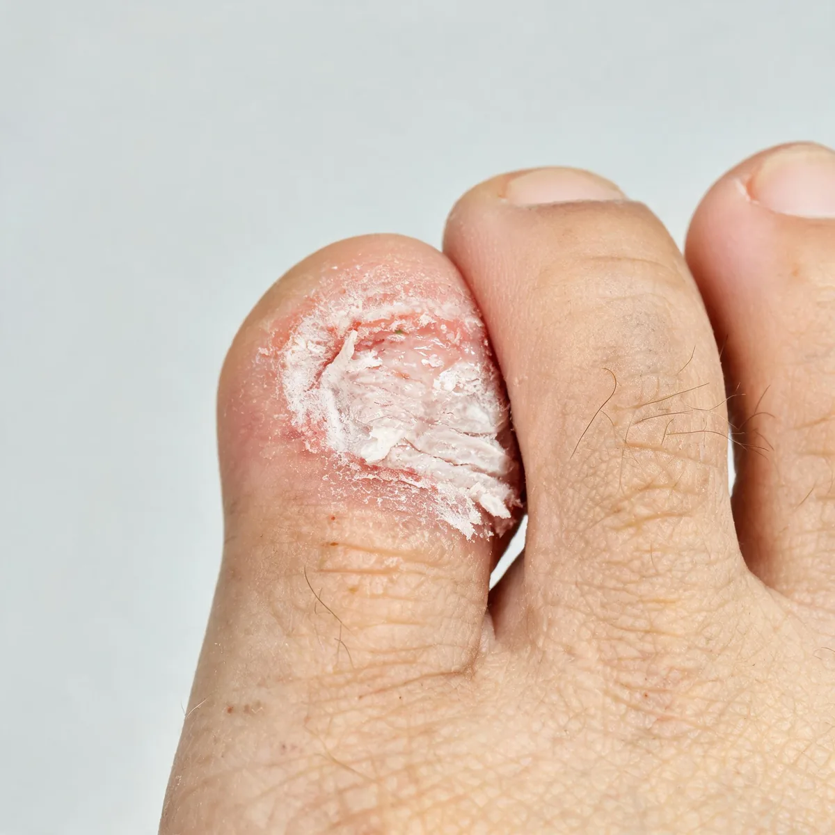 Sole and toe webs of a foot showing white macerated peeling skin between the fourth and fifth toes with mild redness and fine scaling.