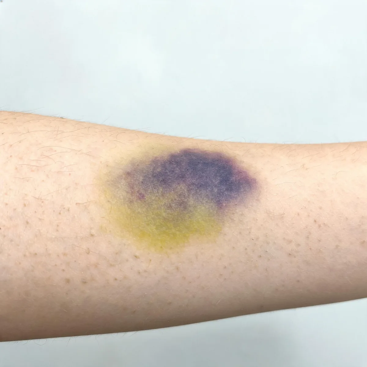 Upper arm showing a resolving bruise: a purple and yellow-green contusion with irregular edges, no break in the skin.