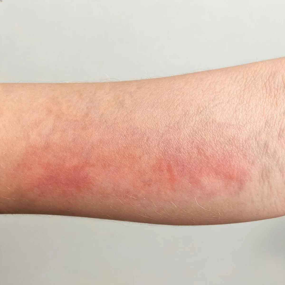 Skin of the forearm showing diffuse mild redness and a flushed warm appearance with normal texture, no burn and no lesion.