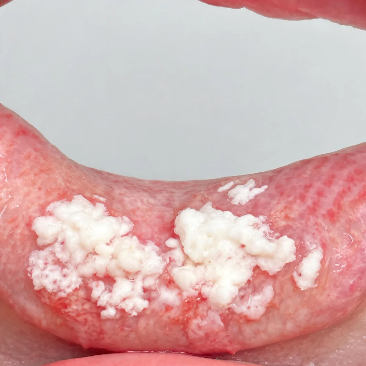 Inside of a mouth showing white curd-like patches on the buccal mucosa with a little underlying redness, lips at the edge of frame only, no.