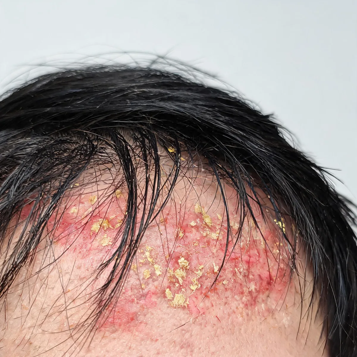Scalp along the hairline showing greasy yellowish flakes and mild redness on the scalp skin between dark hair strands.