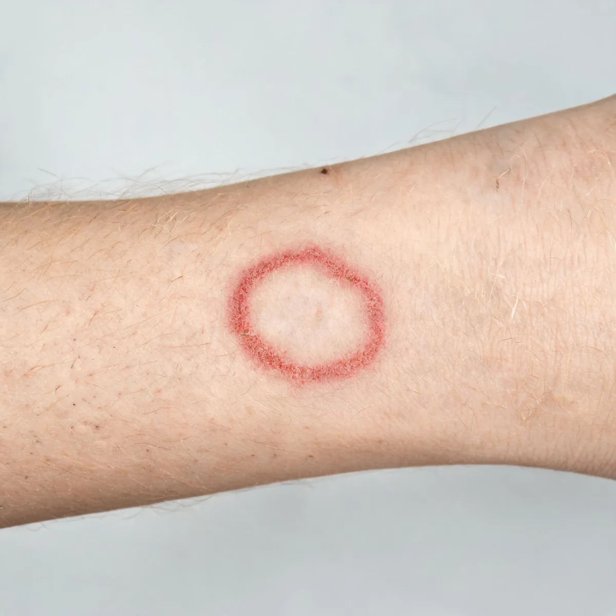 Outside of a forearm showing a ring-shaped scaly plaque with a raised red border and central clearing.