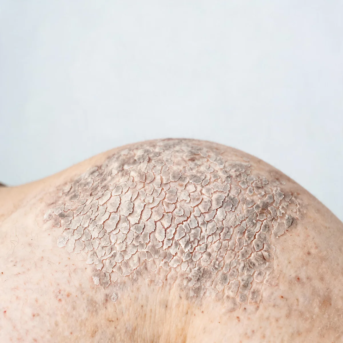 Flank showing rough, dry, cracked, fish-scale patterned skin with a mottled dusky appearance, armour-like texture.