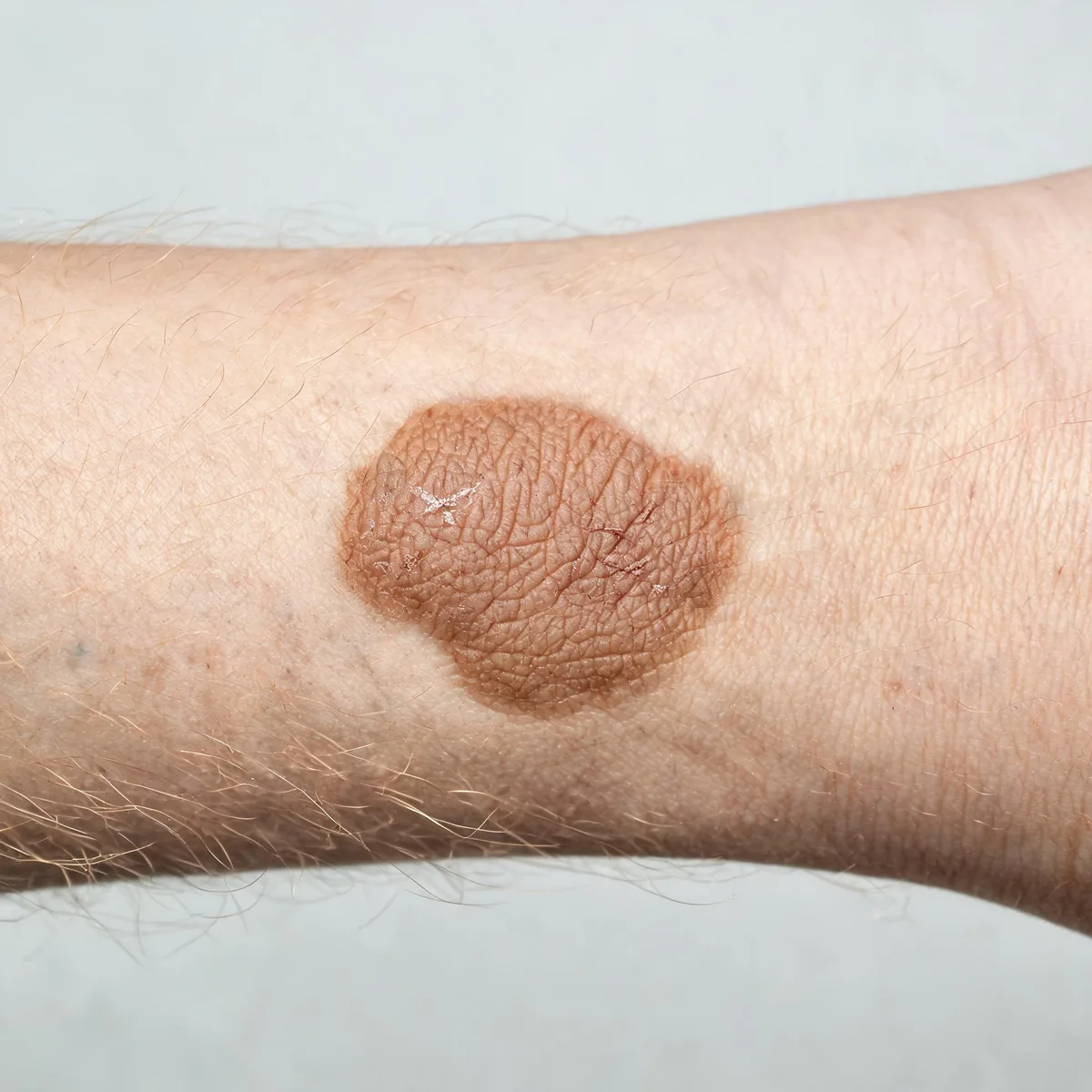 Outside of a forearm showing a single thickened, lichenified, hyperpigmented plaque with exaggerated skin markings and excoriation.
