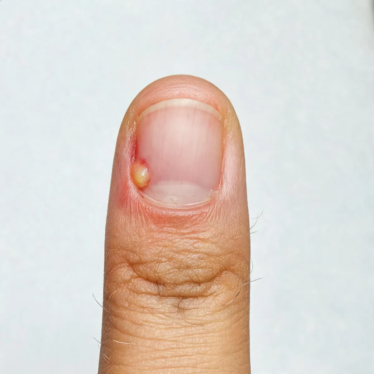 One finger showing red swollen nail fold with mild swelling and a small collection of pus at the cuticle edge, nail visible, no hand.