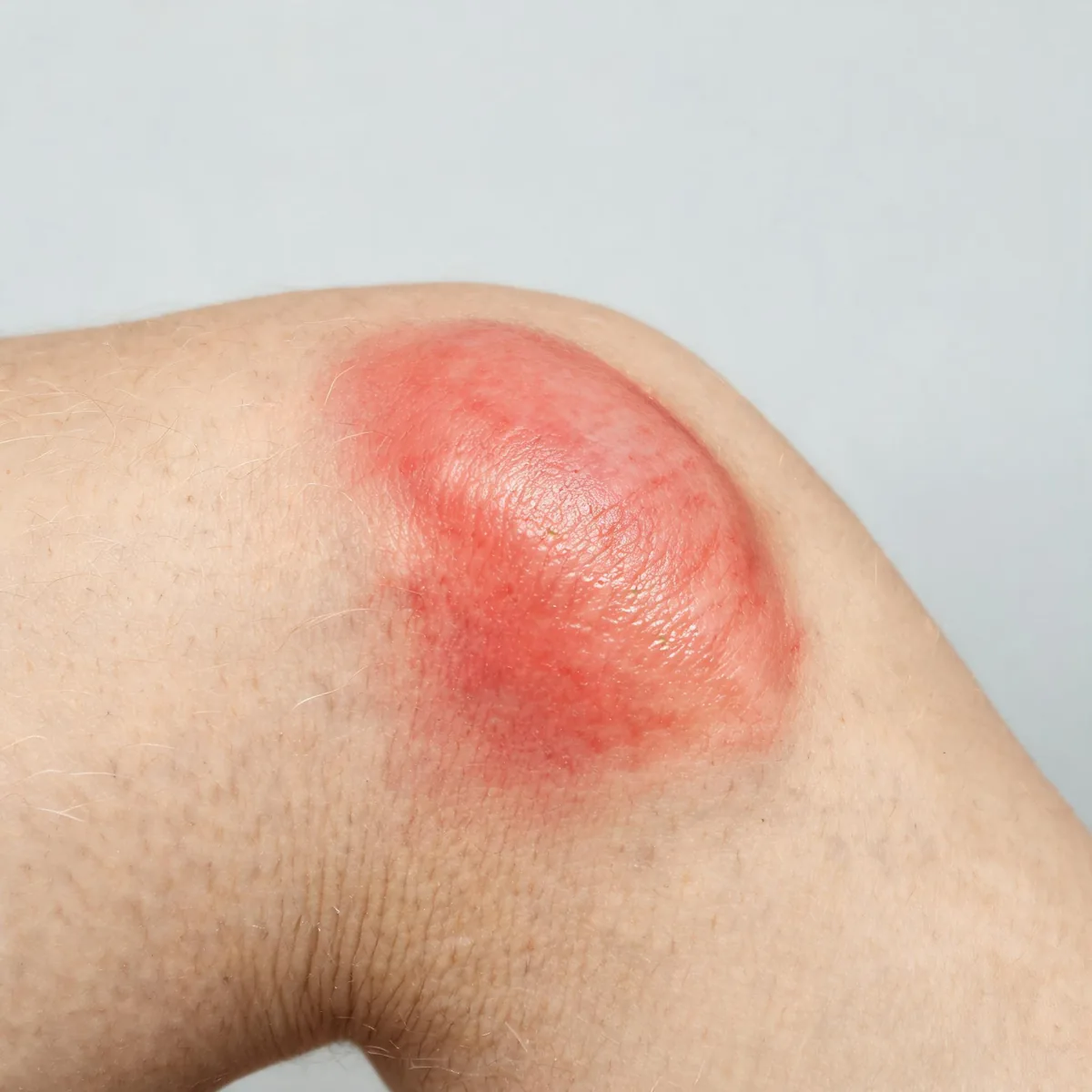 Elbow showing a bright red, hot, swollen area over the olecranon with a tense shiny surface, no pus head.