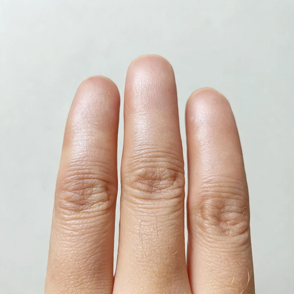 Fingers of one hand showing tight, shiny, thickened skin with loss of skin creases and mild tapering, no face.