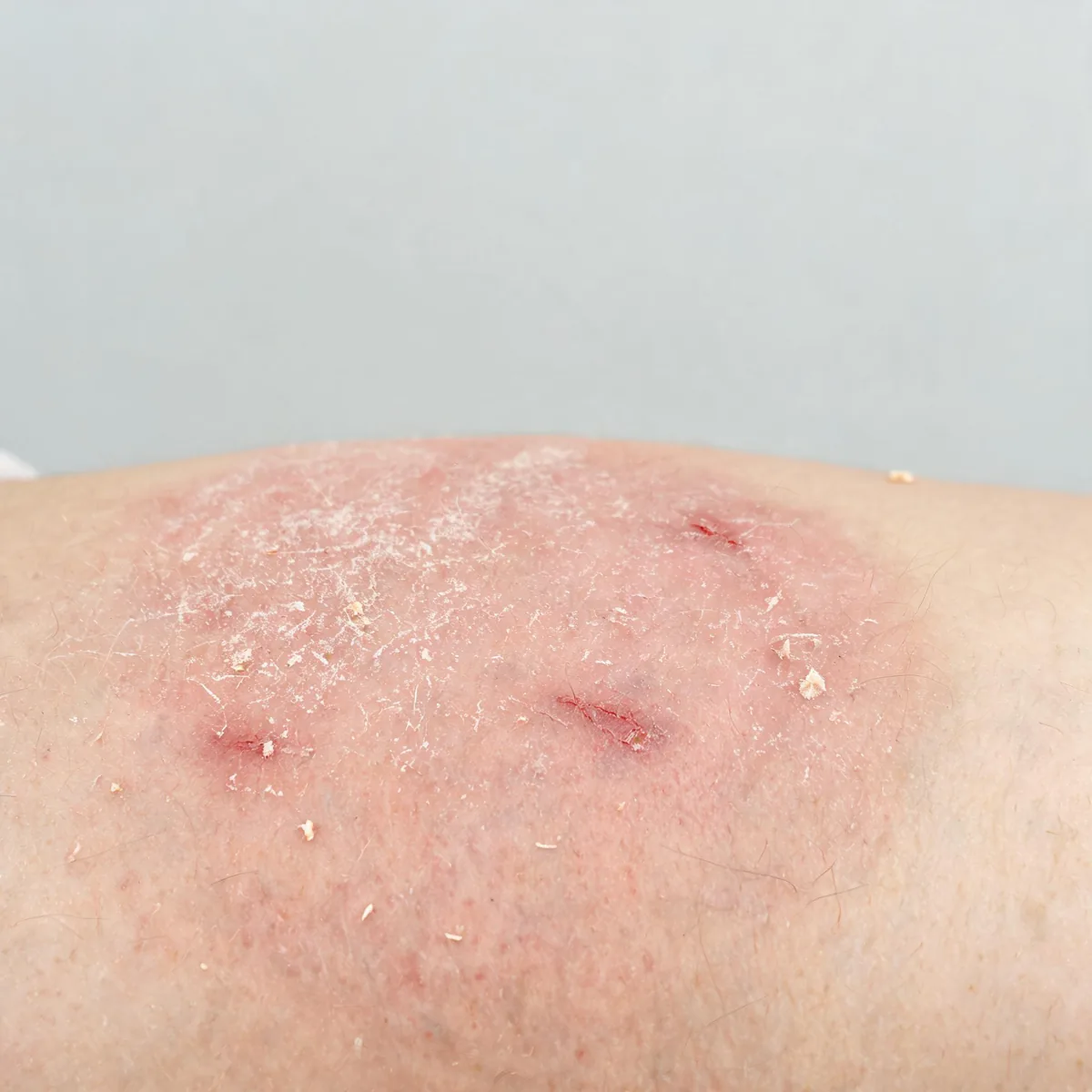 Abdomen showing dry, tight, mildly red skin with fine scaling and a few small excoriations, no rash.