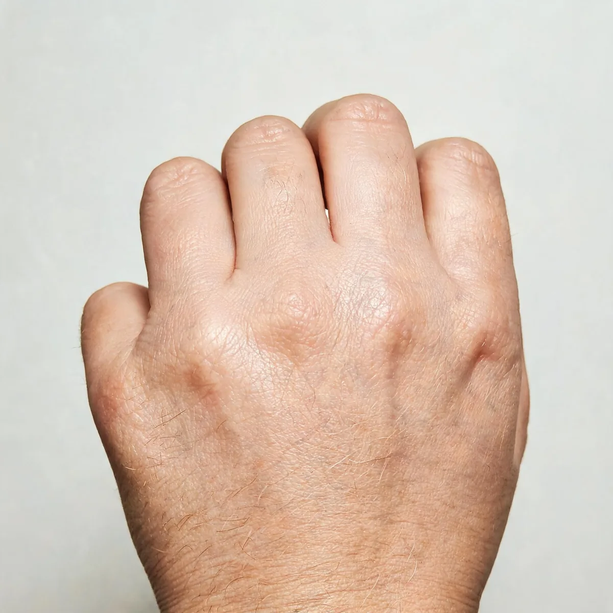 Back of the hand and fingers showing tight, shiny skin with reduced creases and mild contracture, no face.